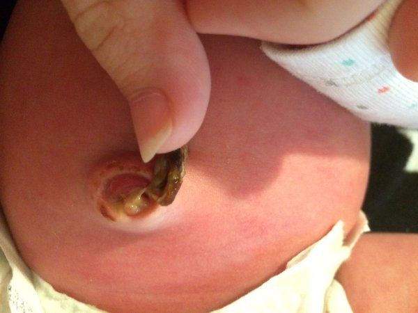 Hình ảnh rốn trẻ sơ sinh bị nhiễm trùng và cách xử lý