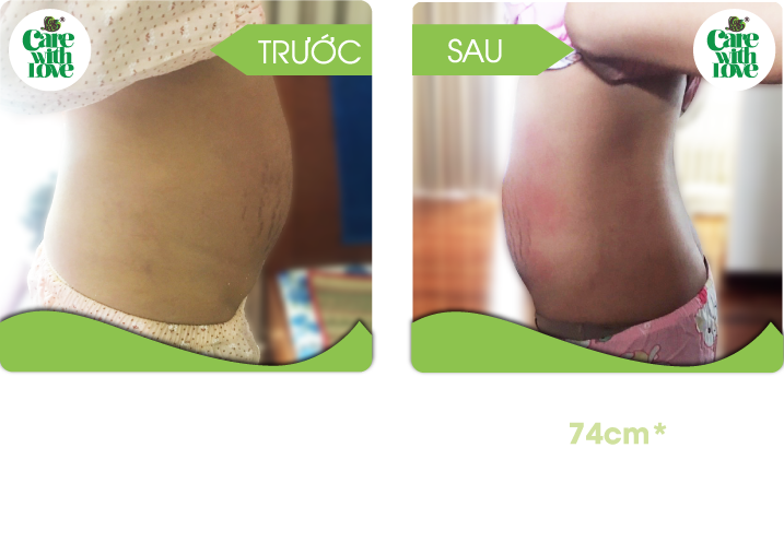 Chị Ân, Toàn diện sau sinh 20 buổi