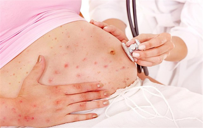 Thuỷ đậu - Một trong các bệnh thường gặp khi mang thai mẹ có thể bị