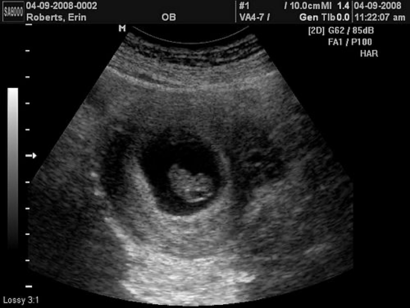 Xét nghiệm 3 tháng đầu thai kỳ
